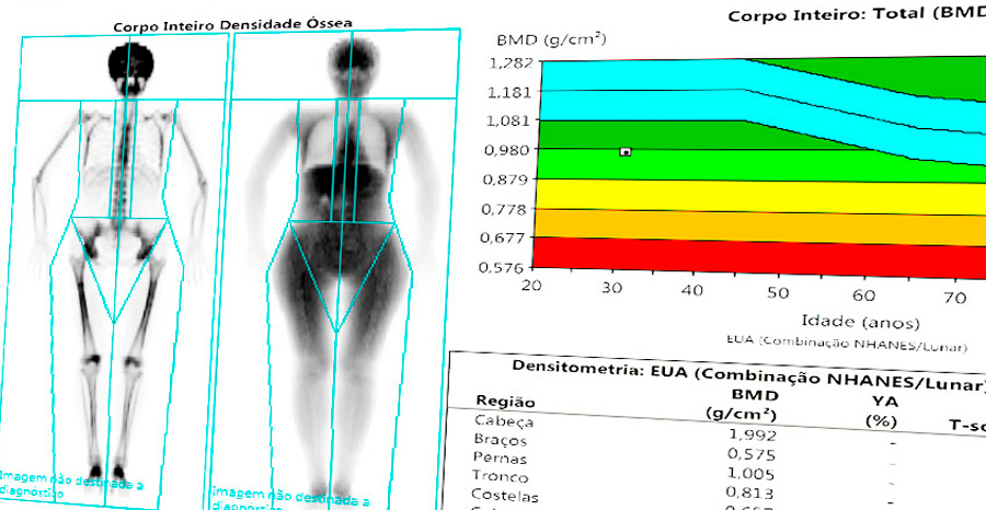 Densitometria de Composição Corporal